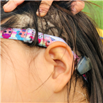 Bone Anchored hearing aid (BAHA)